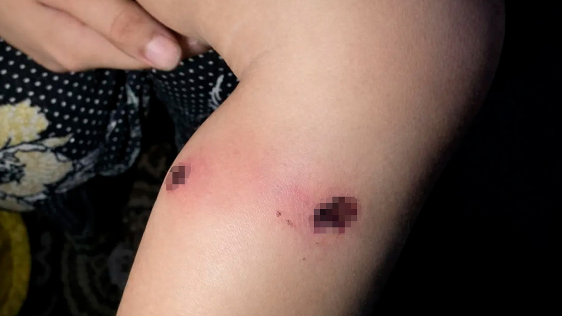 Huellas dejadas en una pierna de Karim Abu Nassar y documentadas tras su devolución a Gaza. QudsNen