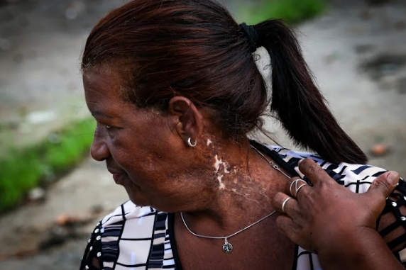 Luiza Odete muestra las cicatrices dejadas por el contacto con el cesio-137. Crédito: Hugo Barreto/Metrópoles @hugobarretophotos